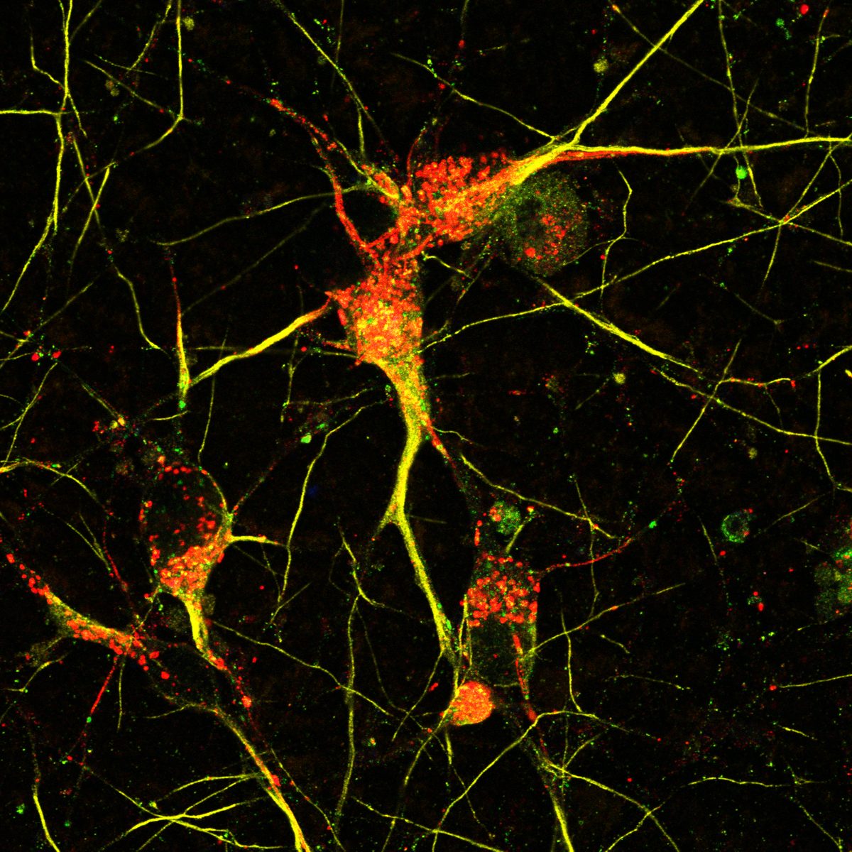 GBA KO neurons showing enlarged LAMP1 lysosomes with accumulated PFF-488 fibrils