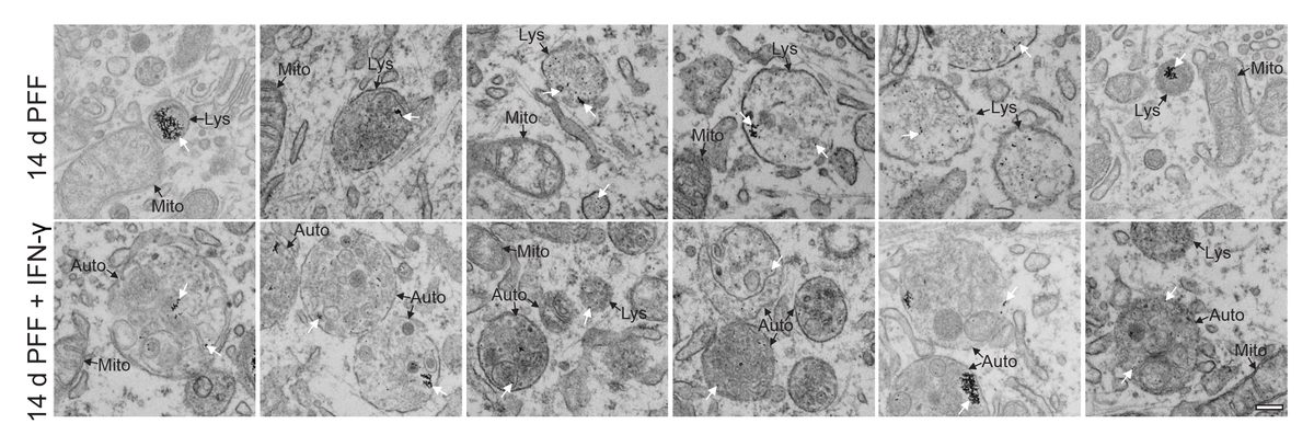 Electron microscopy of lysosomal dysfunction