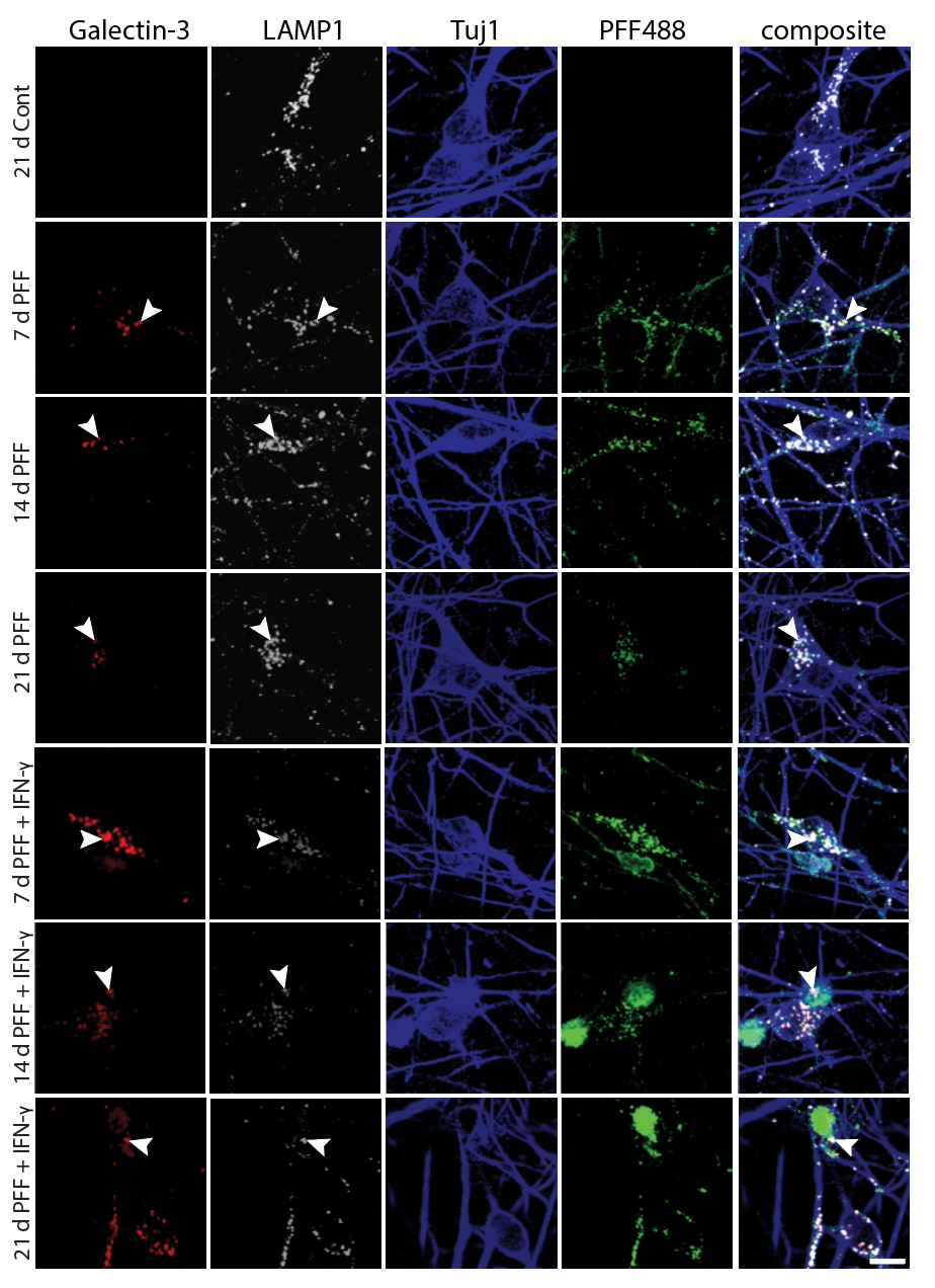 Galectin-3 puncta indicating lysosomal disruption