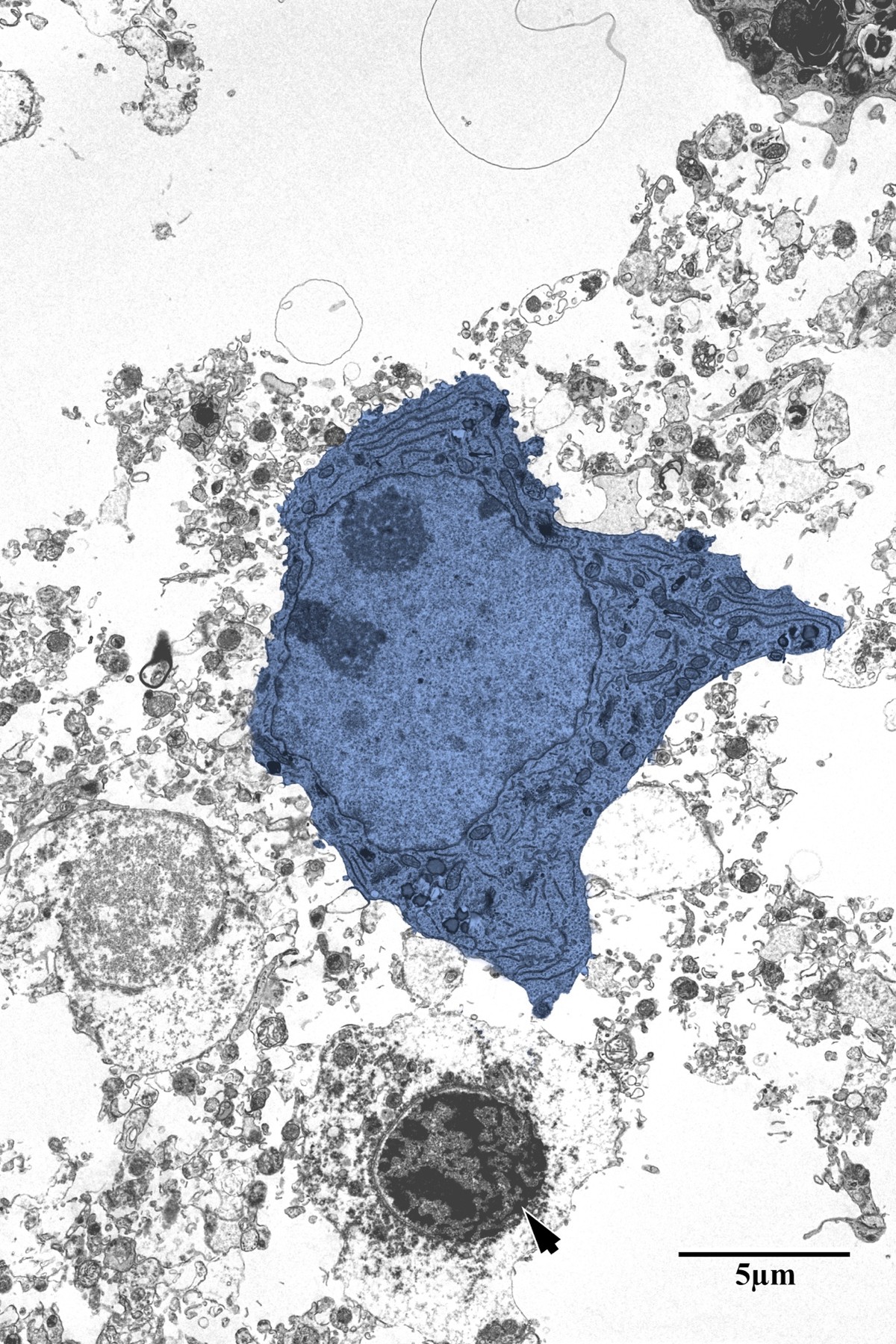 Degenerating neuron and pyknotic glial cell in the necrotic core
