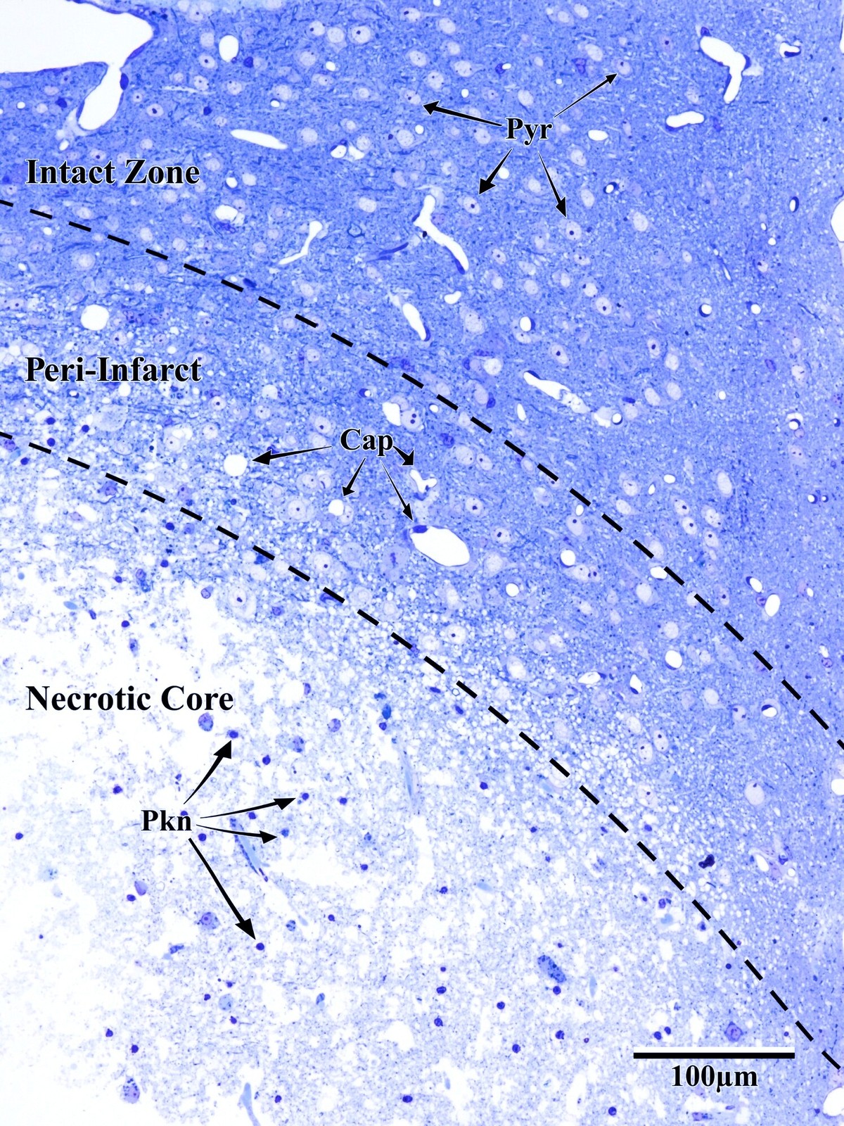 Toluidine blue section showing intact zone, peri-infarct, and necrotic core