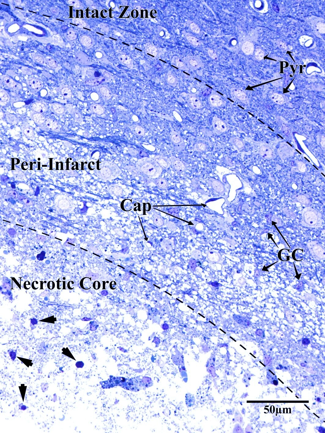 High magnification toluidine blue showing peri-infarct zone detail