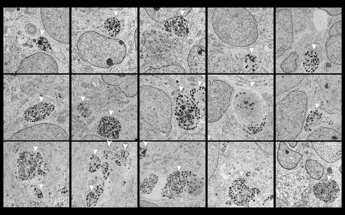 EM montage of Lewy body-like inclusions across multiple neurons