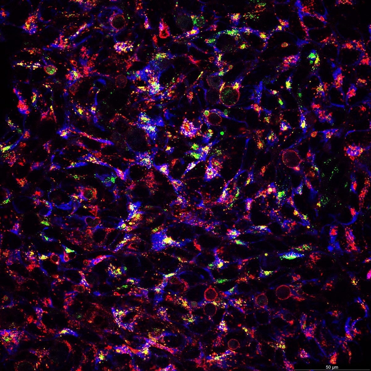 SH-SY5Y Tom20 LAMP1 PFF overlay showing mitochondria-lysosome-fibril interactions
